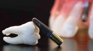 El implante sustituye el diente perdido.